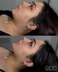 RF Facial Slimming Combo: Lymphatic Drainage + Fat Dissolving (Chin, Cheeks, Jaw)