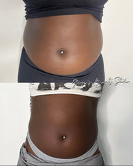 Fat Dissolving Large Area (Full Stomach, Full Back)