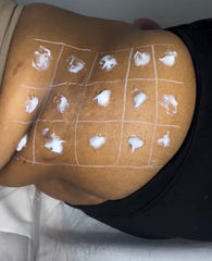 Fat Dissolving Medium Area (Arms, Lower Stomach, Love Handles, Upper Stomach, Bra Strap Fat)
