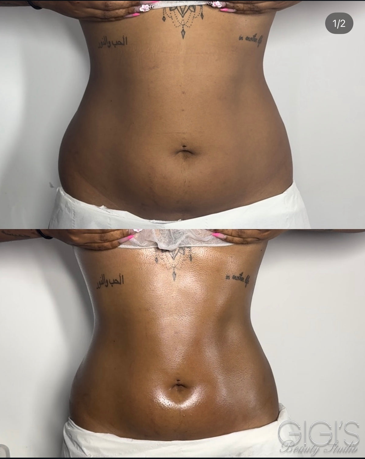 Body Contouring Treatment