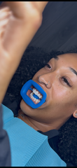 Cosmetic Teeth Brightening